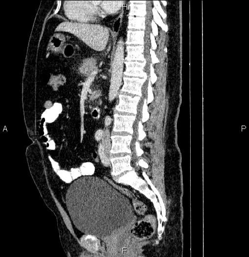 Acute pancreatitis (Radiopaedia 85390-101010 Sagittal C+ portal venous phase 51).jpg