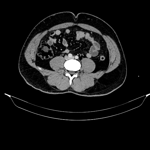 Acute pancreatitis (Radiopaedia 87428-103757 Axial C+ portal venous phase 64).jpg
