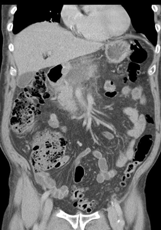 Acute pancreatitis and walled-off necrosis (Radiopaedia 29888-30403 E 22).jpg