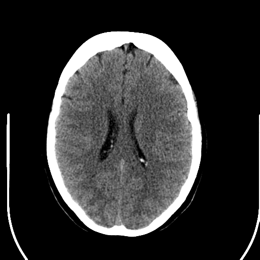 File:Acute pontine infarct from vertebral artery dissection (Radiopaedia 34111-35369 Axial non-contrast 18).png