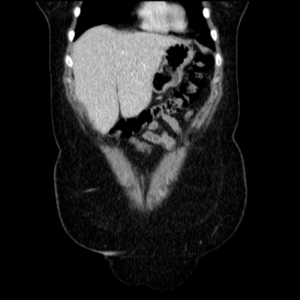 Acute pyelonephritis (Radiopaedia 33397-34434 Coronal renal parenchymal phase 22).jpg