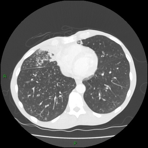 File:Acute right lung abscess (Radiopaedia 34806-36258 Axial lung window 133).jpg