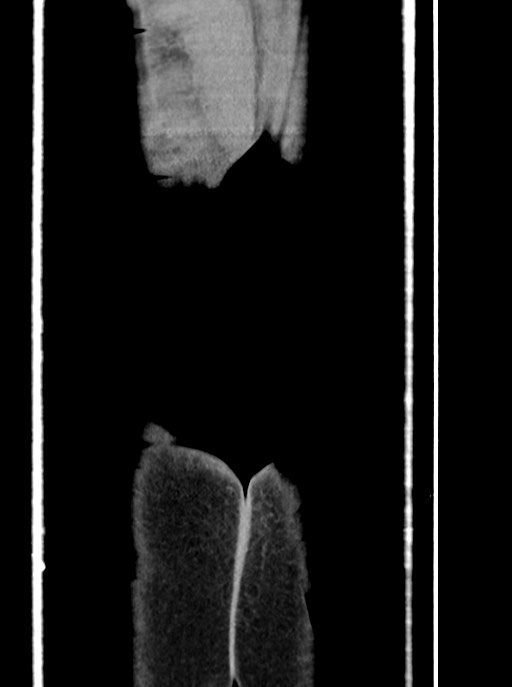 Acute small bowel (ileal) volvulus (Radiopaedia 71740-82139 Coronal C+ portal venous phase 114).jpg