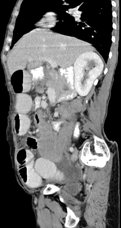 Acute small bowel (ileal) volvulus (Radiopaedia 71740-82139 Sagittal C+ portal venous phase 108).jpg