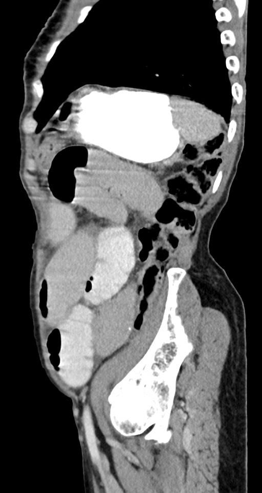 Acute small bowel (ileal) volvulus (Radiopaedia 71740-82139 Sagittal C+ portal venous phase 48).jpg