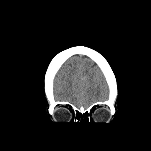 Acute subarachnoid hemorrhage and accessory anterior cerebral artery (Radiopaedia 69231-79008 Coronal non-contrast 17).jpg