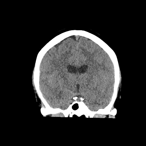 Acute subarachnoid hemorrhage and accessory anterior cerebral artery (Radiopaedia 69231-79008 Coronal non-contrast 36).jpg