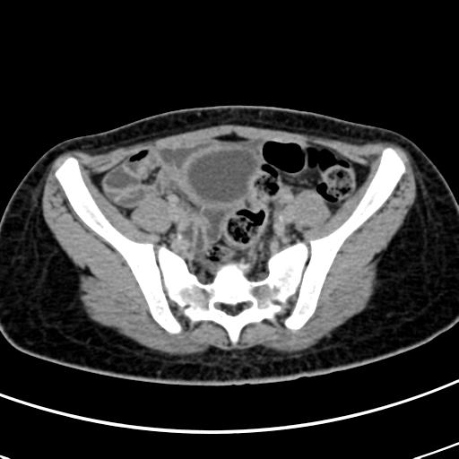File:Acute suppurative pyelonephritis (Radiopaedia 18306-18147 Axial renal excretory phase 128).jpg