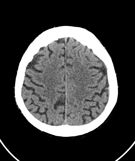Acute traumatic subdural hematoma (Radiopaedia 82921-97257 Axial non-contrast 21).jpg