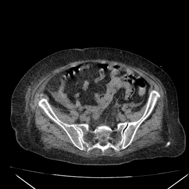 Acute tubular necrosis (Radiopaedia 28077-28334 Axial non-contrast 52).jpg