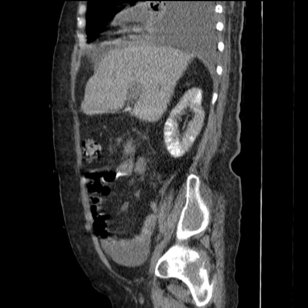 Acute tubular necrosis (Radiopaedia 28077-28334 H 32).jpg