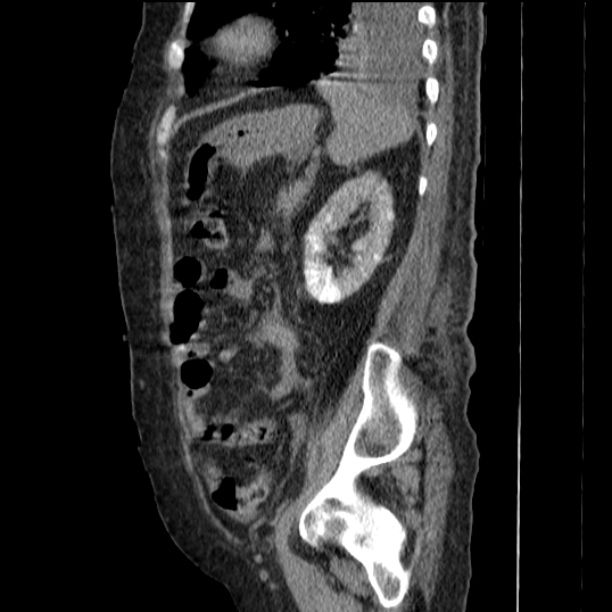 Acute tubular necrosis (Radiopaedia 28077-28334 Sagittal non-contrast 63).jpg