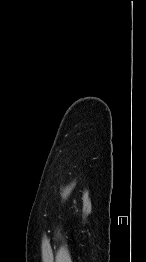 Acute uncomplicated appendicitis (Radiopaedia 61374-69304 Sagittal C+ portal venous phase 104).jpg
