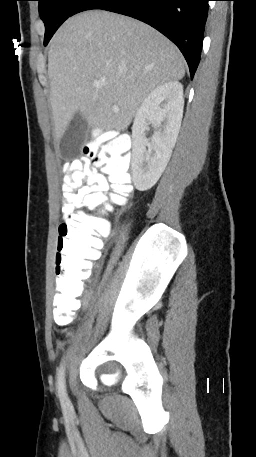 Acute uncomplicated appendicitis (Radiopaedia 61374-69304 Sagittal C+ portal venous phase 74).jpg