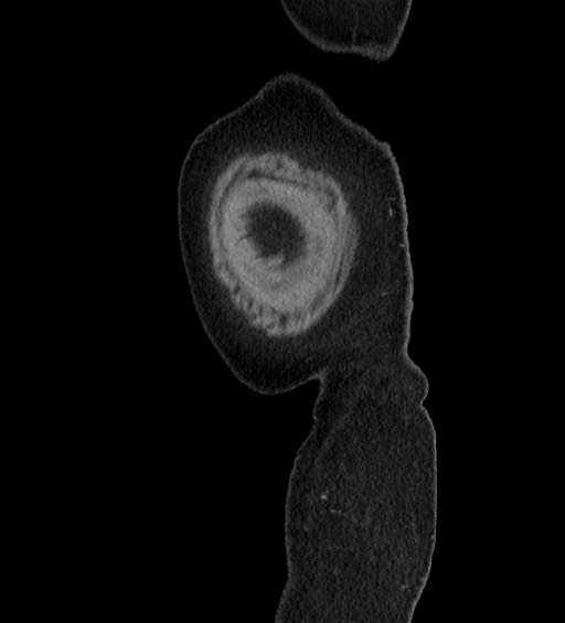 Acute uncomplicated sigmoid diverticulitis (Radiopaedia 82003-95987 Sagittal C+ portal venous phase 1).jpg