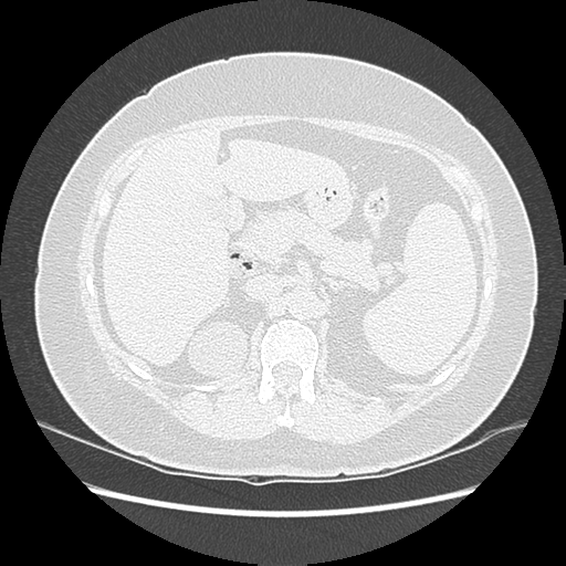 Adenocarcinoma in situ of lung (Radiopaedia 38685-40829 B 229).png