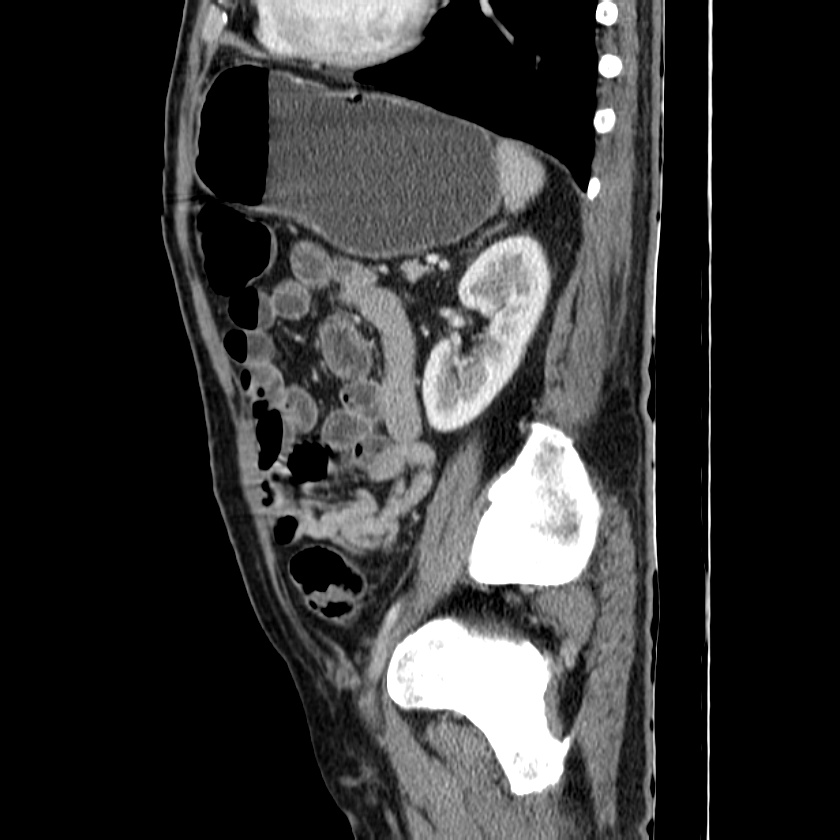 Adenocarcinoma of colon with entero-colic fistula (Radiopaedia 22832-22852 Sagittal C+ portal venous phase 45).jpg