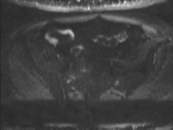 Adenocarcioma of rectum- T1 lesion (Radiopaedia 36921-38546 Axial DWI 21).png