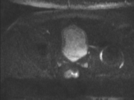 Adenocarcioma of rectum- T1 lesion (Radiopaedia 36921-38546 Axial DWI 45).png