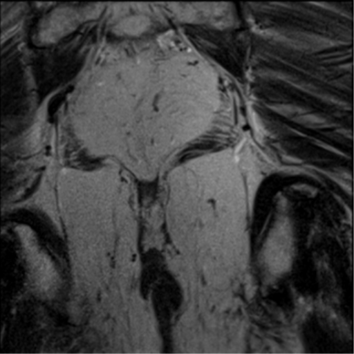 File:Adenocarcioma of rectum- T1 lesion (Radiopaedia 36921-38546 Coronal T2 3).png