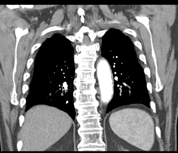 Adenocarcioma of rectum- T1 lesion (Radiopaedia 36921-38547 Coronal C+ arterial phase 46).png