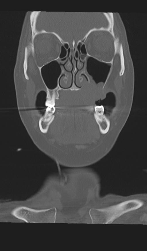 Adenoid cystic tumor of palate (Radiopaedia 46980-51518 Coronal bone window 22).png