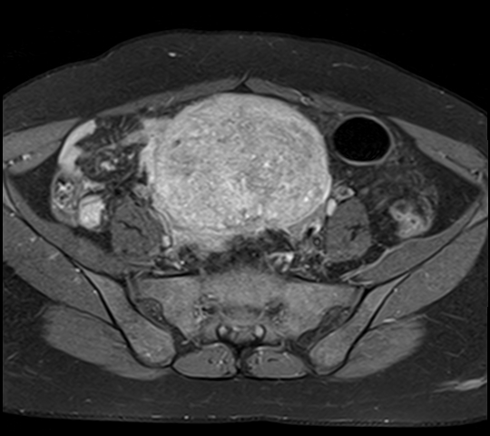File:Adenomyosis - ovarian endometriomas (Radiopaedia 67031-76350 Axial T1 C+ fat sat 8).jpg