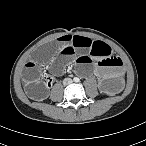 Adhesional small bowel obstruction (Radiopaedia 52107-57980 Axial C+ portal venous phase 72).jpg