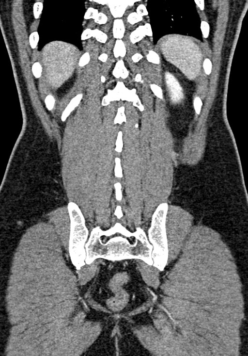 Adhesional small bowel obstruction (Radiopaedia 58900-66131 Coronal C+ portal venous phase 204).jpg
