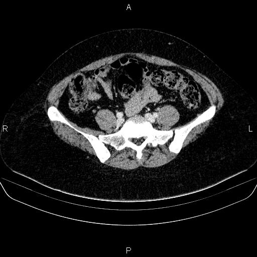 Adrenal cortical carcinoma (Radiopaedia 84882-100379 Axial C+ portal venous phase 67).jpg