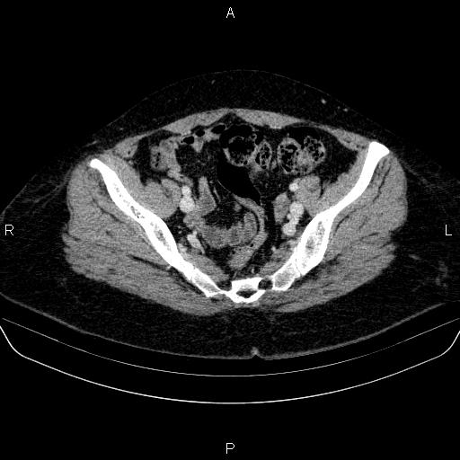 File:Adrenal cortical carcinoma (Radiopaedia 84882-100379 Axial C+ portal venous phase 79).jpg