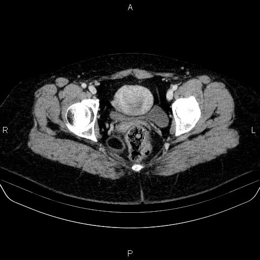 Adrenal cortical carcinoma (Radiopaedia 84882-100379 Axial C+ portal venous phase 90).jpg
