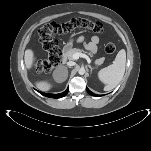 File:Adrenal cyst (Radiopaedia 45625-49778 AXIAL THICK 60 sec 22).png