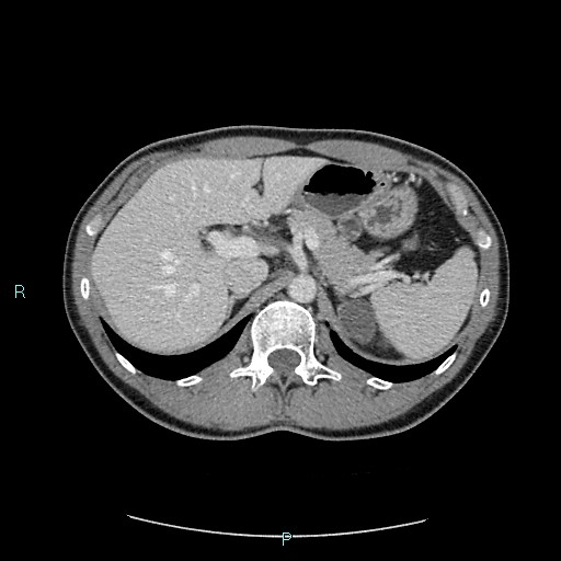 Adrenal cystic lymphangioma (Radiopaedia 83161-97534 Axial C+ portal venous phase 27).jpg