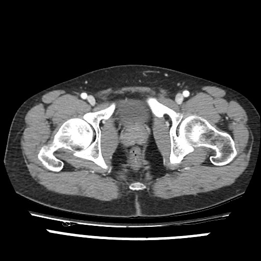 File:Adrenal gland trauma (Radiopaedia 81351-95078 Axial Dual bolus trauma C+ 119).jpg