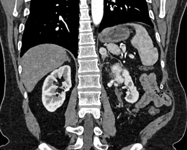 Adrenal metastases (Radiopaedia 73082-83791 Coronal C+ arterial phase 51).jpg