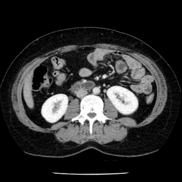 Adrenal myelolipoma (Radiopaedia 43401-46759 Axial C+ portal venous phase 44).jpg