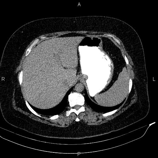 File:Adrenal myelolipoma (Radiopaedia 84319-99617 Axial With oral contrast 45).jpg