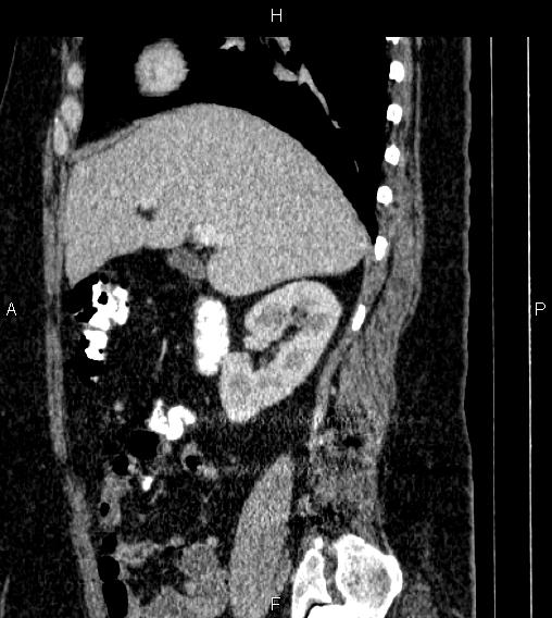 Adrenal myelolipoma (Radiopaedia 84319-99617 Sagittal renal cortical phase 31).jpg