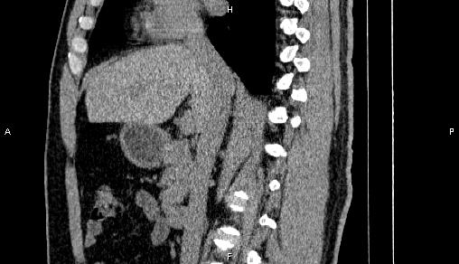 Adrenal myelolipoma (Radiopaedia 84321-99619 Sagittal non-contrast 47).jpg
