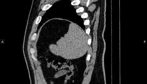 File:Adrenal myelolipoma (Radiopaedia 84321-99619 Sagittal non-contrast 97).jpg