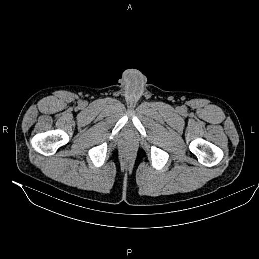 Adrenal myelolipoma (Radiopaedia 87794-104246 Axial non-contrast 114).jpg