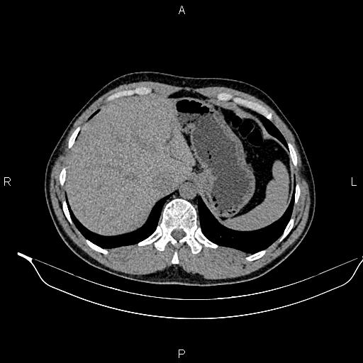 File:Adrenal myelolipoma (Radiopaedia 87794-104246 Axial non-contrast 21).jpg