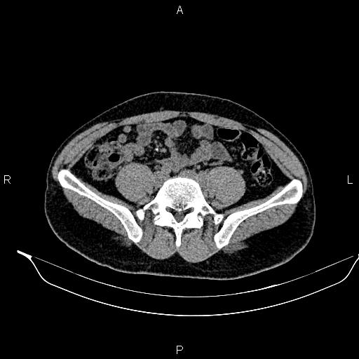 Adrenal myelolipoma (Radiopaedia 87794-104246 Axial non-contrast 73).jpg