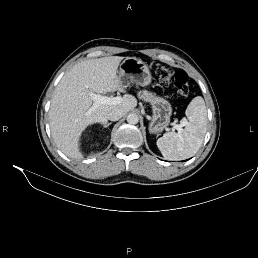 Adrenal myelolipoma (Radiopaedia 87794-104246 Axial renal cortical phase 26).jpg