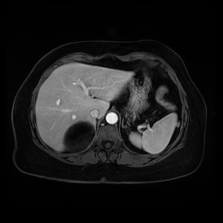 Adrenal myelolipoma - MRI (Radiopaedia 83249-97646 T1 fat sat arterial phase 18).jpg