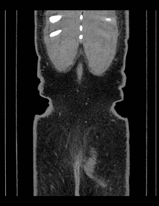Adrenal myelolipoma - bilateral (Radiopaedia 74805-85810 Coronal C+ portal venous phase 42).jpg