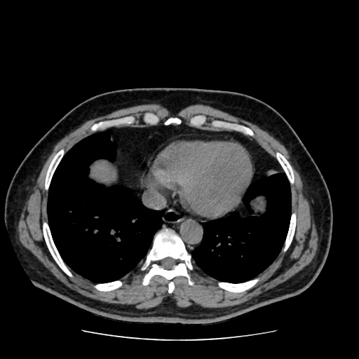 Adrenal myelolipoma and beaver tail liver (Radiopaedia 86201-102193 Axial non-contrast 7).jpg