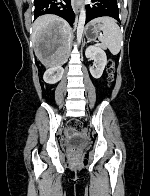 Adrenocortical carcinoma (Radiopaedia 87281-103569 Coronal C+ portal venous phase 77).jpg