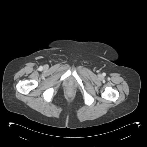 Adult ileal intussusception with secondary obstruction (Radiopaedia 30395-31051 Axial C+ portal venous phase 82).jpg